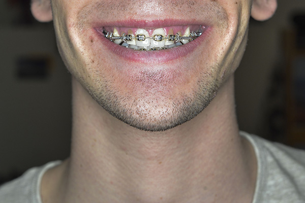 devon manus add twinks with braces photo